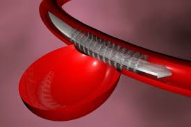 Cardioangiología: crece el uso de técnicas por cateterismo para tratar enfermedades de las válvulas cardíacas Cardioangiología: crece el uso de técnicas por cateterismo para tratar enfermedades de las válvulas cardíacas