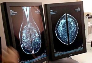 Telemamografías para diagnóstico del cáncer de mama en&nbsp;Perú