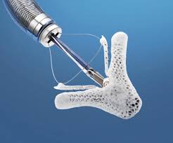 Dispositivo MitraClip: un tratamiento percutáneo para la insuficiencia mitral Dispositivo MitraClip: un tratamiento percutáneo para la insuficiencia mitral