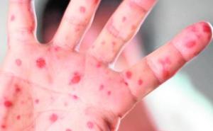 Alerta epidemiológica del Ministerio de Salud de la Nación por casos de sarampión en Argentina Alerta epidemiológica del Ministerio de Salud de la Nación por casos de sarampión en Argentina