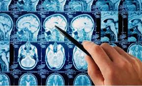 Envejecimiento cognitivo saludable: la importancia de la plasticidad neuronal y de la reserva&nbsp;cognitiva