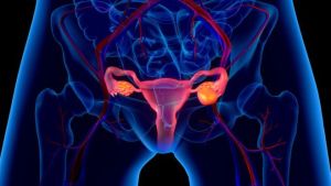 El 70% de los casos de cáncer de ovario se diagnostica en etapas&nbsp;avanzadas