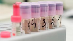 Con Novartis. Ensayos clínicos para prevenir el Alzheimer se realizan en Barcelona Con Novartis. Ensayos clínicos para prevenir el Alzheimer se realizan en Barcelona