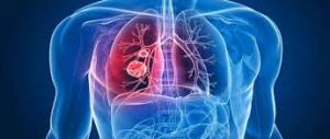 Avances en hipertensión arterial pulmonar se presentaron en Buenos Aires Avances en hipertensión arterial pulmonar se presentaron en Buenos Aires