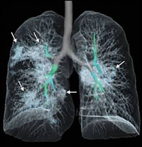 La Sociedad de Radiología de Norteamérica publicó un video 3D obtenido de escaneos de los pulmones de un paciente con Covid-19. La Sociedad de Radiología de Norteamérica publicó un video 3D obtenido de escaneos de los pulmones de un paciente con Covid-19.