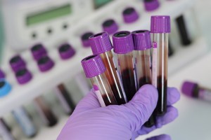 Una mala práctica en un laboratorio de análisis clínico: relato&nbsp;personal