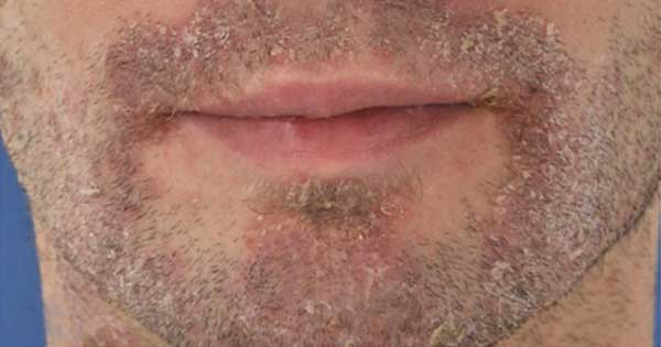 Mitos de los pacientes sobre la psoriasis y consejos para erradicarlos