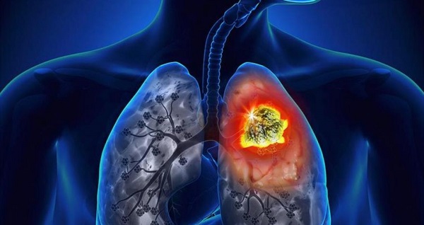 Cáncer de pulmón: se diagnosticaron más de 285 mil casos en el mundo en personas de 54 años o menos